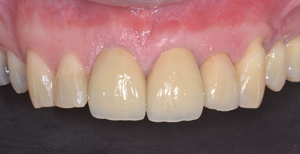 After Treatment