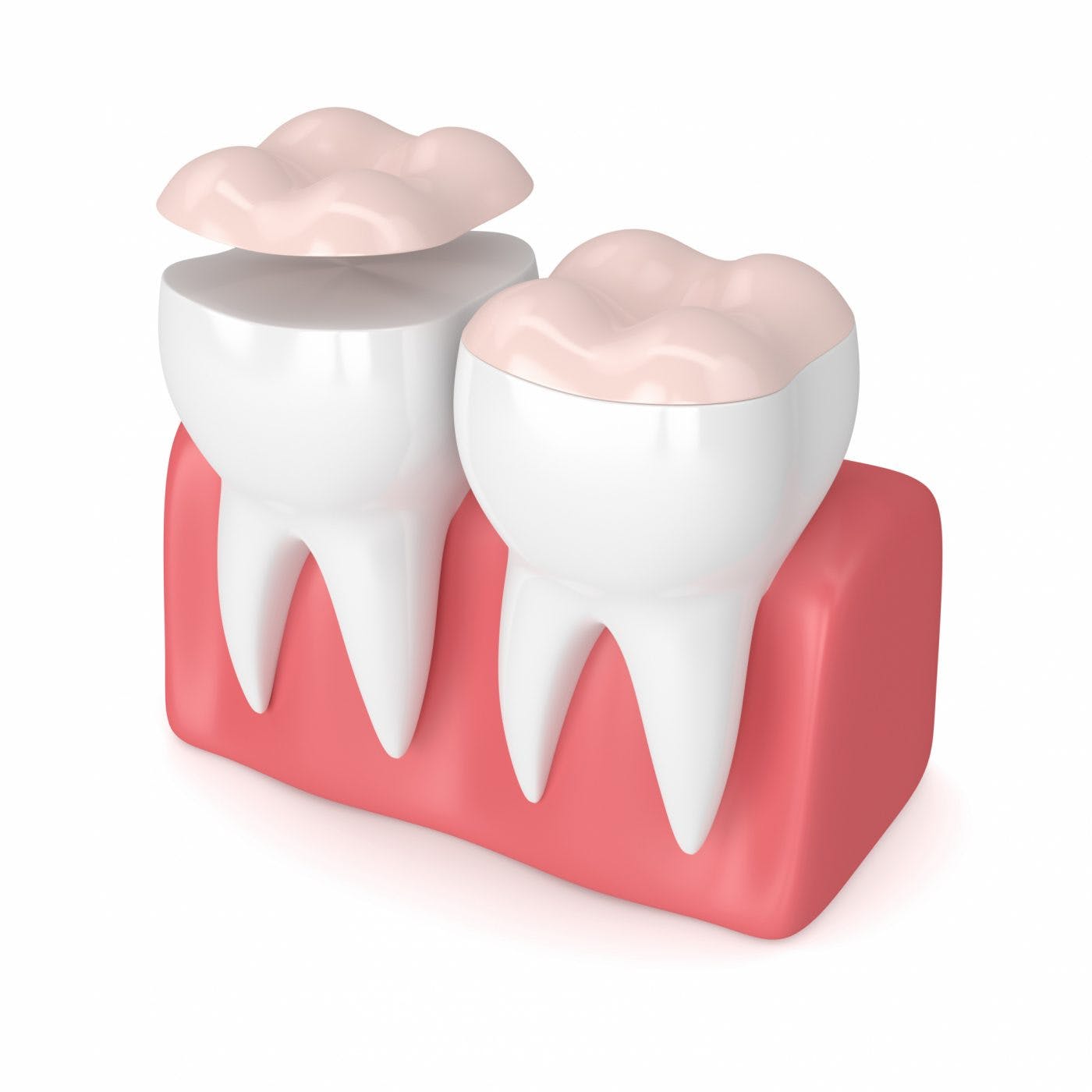 Dental Onlays